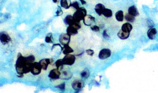 Pneumocystis jiroveci cysts
