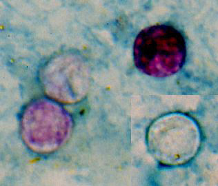 Cyclospora oocysts, modified acid-fast stain