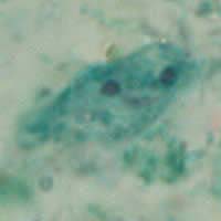 Dientamoeba fragilis trophozoite, trichrome stain