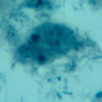 Dientamoeba fragilis trophozoite, trichrome stain