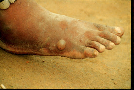 Blister induced by female guinea worm