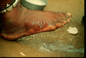 Guinea worm emerges from ruptured blister