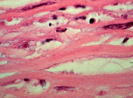 Acanthamoeba sp. trophozoite in a corneal biopsy