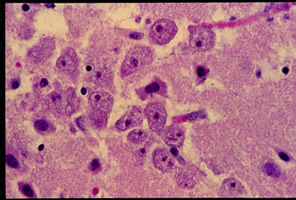 Balamuthia mandrillaris trophozoites in brain tissue