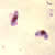 Gametocytes of P. falciparum in a thick blood smear
