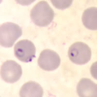 P. falciparum rings - applique form - thin smear