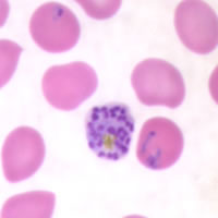 P. falciparum schizonts - thin smear