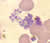 Schizont of P. falciparum in a thin blood smear