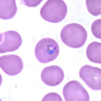 P. falciparum trophozoites - thin smear