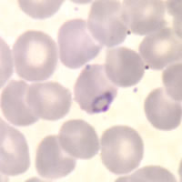 Trophozoites of P. falciparum in a thin blood smear