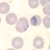 P. falciparum trophozoites - thin smear