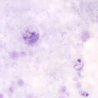 Gametocytes of P. malariae in a thick blood smear