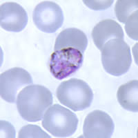 Gametocytes of P. malariae in a thin blood smear
