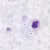 Schizont in a thick blood smear