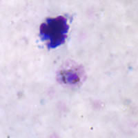 P. ovale trophozoite - thick smear