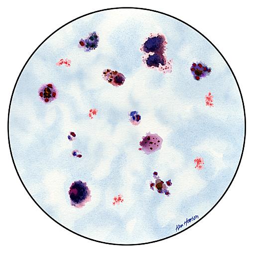 P. ovale thick blood smear