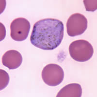 P. vivax gametocyte - thin smear
