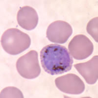 P. vivax gametocyte - thin smear