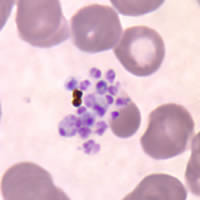 P. vivax schizont - thin smear