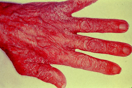 Scabies-infected hand