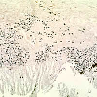 S. japonicum eggs in colon