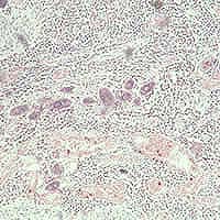 Schistosomiasis in bladder
