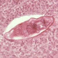 Schistosomiasis in liver 