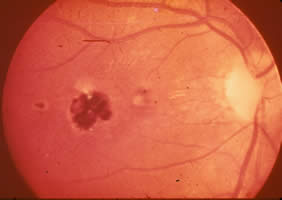 Ocular toxoplasmosis