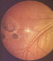 Ocular toxoplasmosis