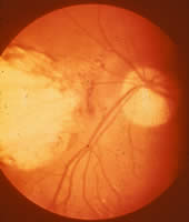 Ocular toxoplasmosis