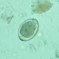 Atypical Trichuris egg