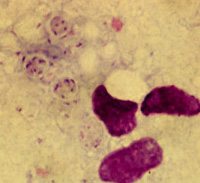 Pneumocystis jiroveci cysts