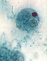 E. histolytica trophozoite with ingested erythrocyte