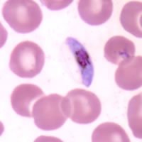 P. falciparum gametocyte - thin smear
