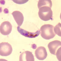 P. falciparum gametocyte - thin smear