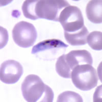 P. falciparum gametocyte - thin smear