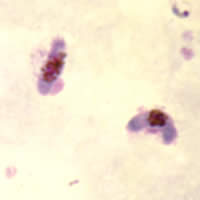 P. falciparum gametocyte - thick smear