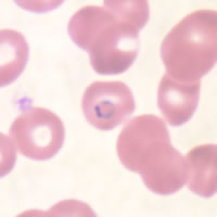 P. falciparum ring - thin smear