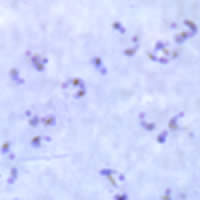 P. falciparum rings - thick smear
