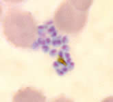 P. falciparum schizonts - thin smear