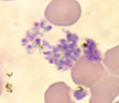 P. falciparum schizonts - thin smear