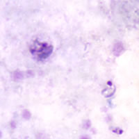 P. malariae rings (lower right) - thick smear