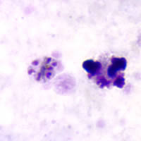 P. malariae schizont - thick smear