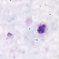 P. ovale schizont - thick smear
