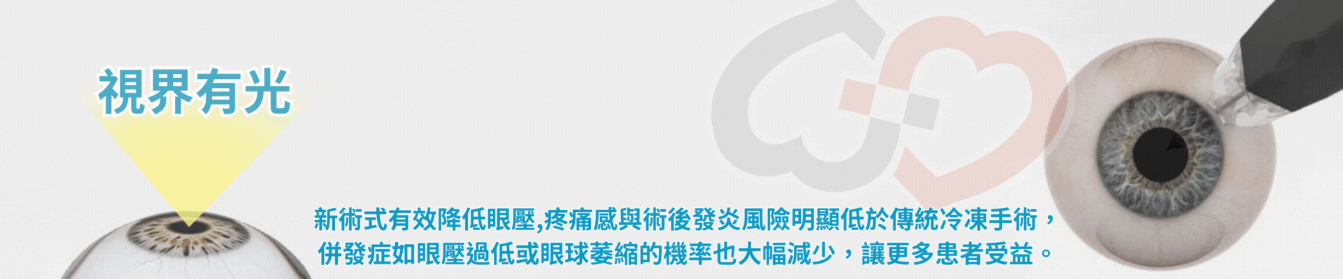 青光眼微脈衝雷射