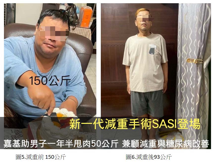 新一代減重手術SASI登場　嘉基助男子一年半甩肉50公斤 兼顧減重與糖尿病改善